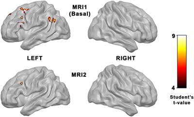 First-Episode Psychotic Patients Showed Longitudinal Brain Changes Using fMRI With an Emotional Auditory Paradigm